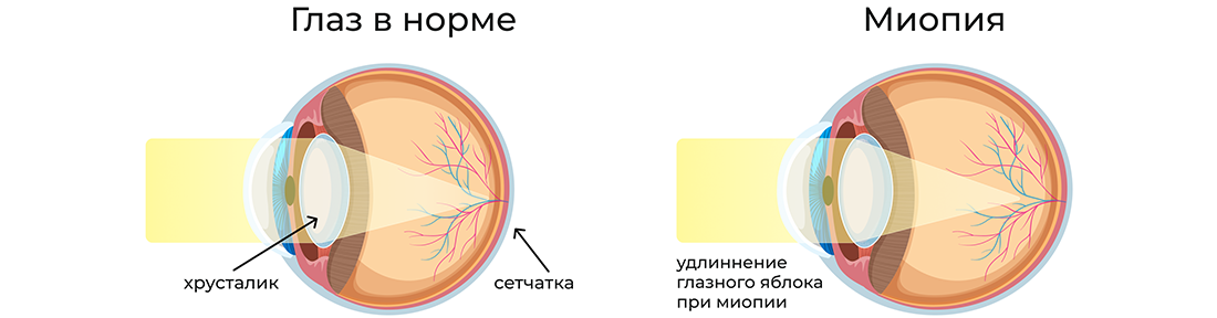 иллюстрация_миопия